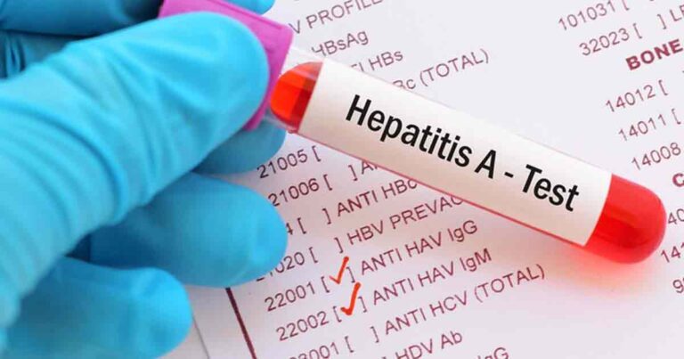 Hepatitis A